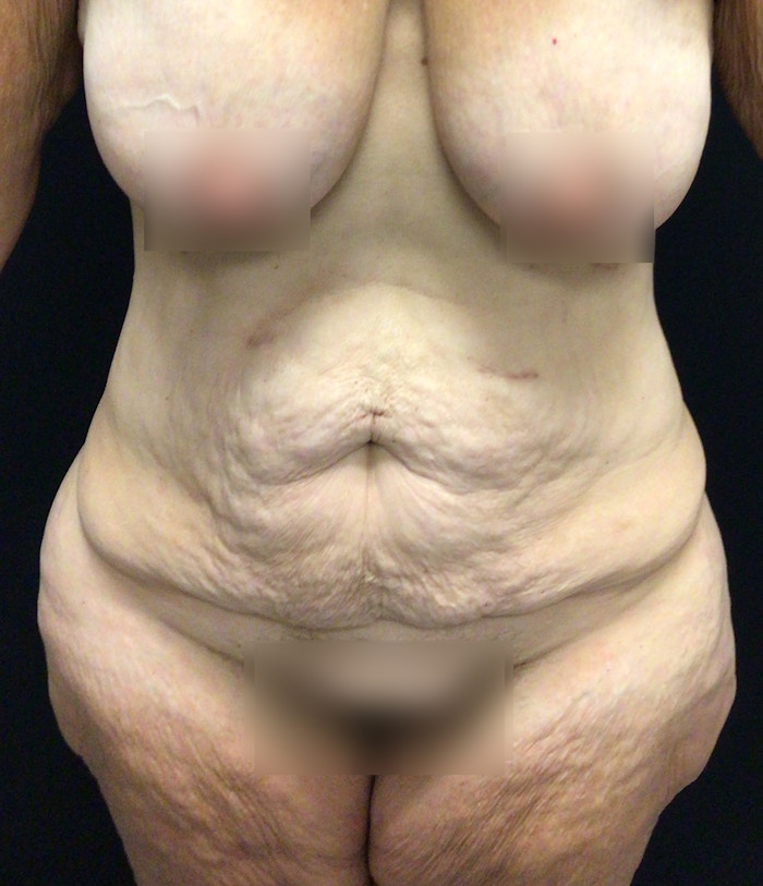Tummy Tuck Before & After Gallery - Patient 58242609 - Image 1
