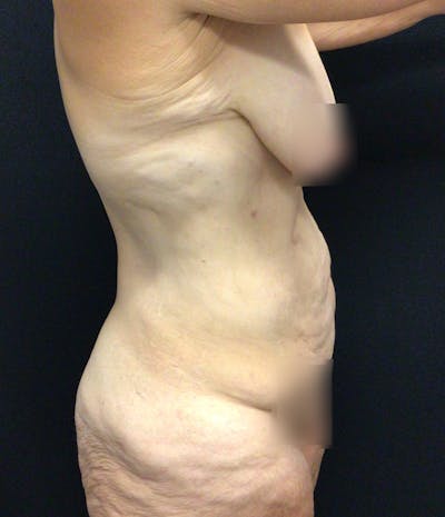 Tummy Tuck Before & After Gallery - Patient 58242609 - Image 5