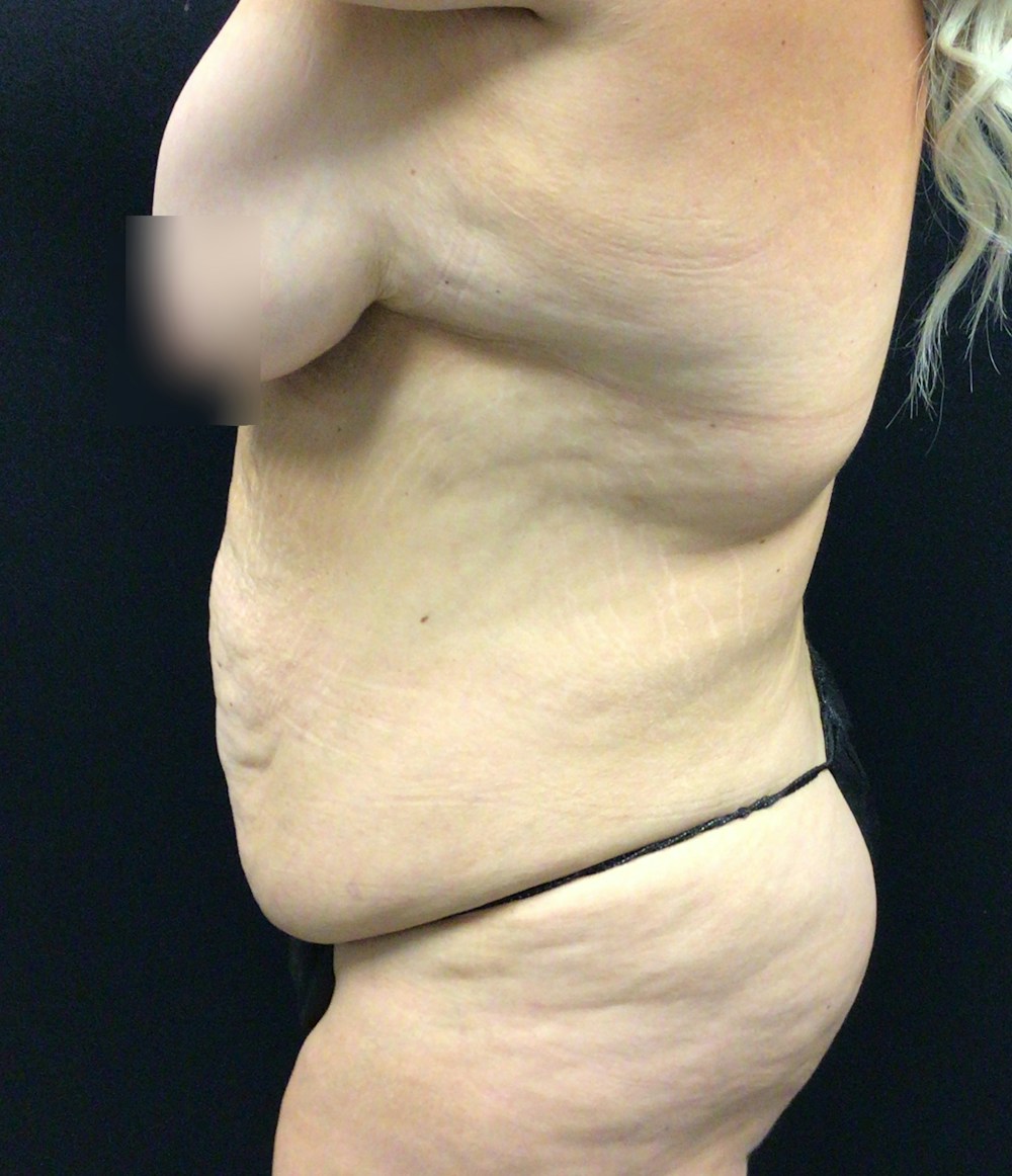Tummy Tuck Before & After Gallery - Patient 58242816 - Image 5