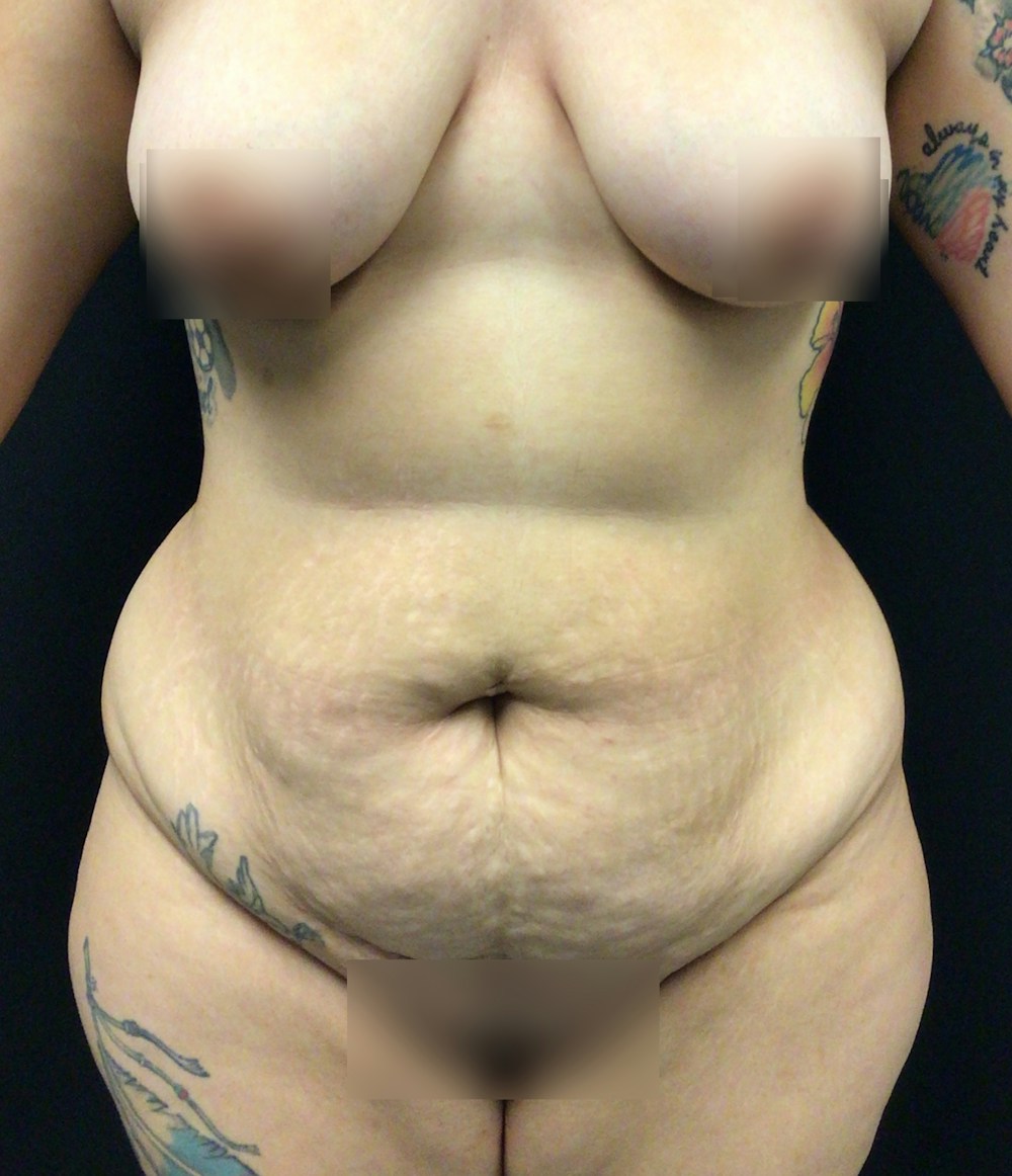 Tummy Tuck Before & After Gallery - Patient 58242838 - Image 1