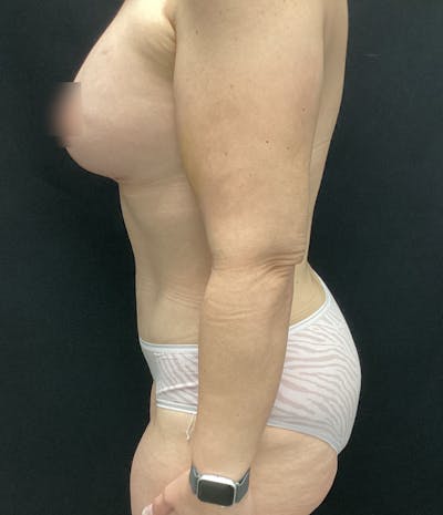 Tummy Tuck Before & After Gallery - Patient 58242645 - Image 6