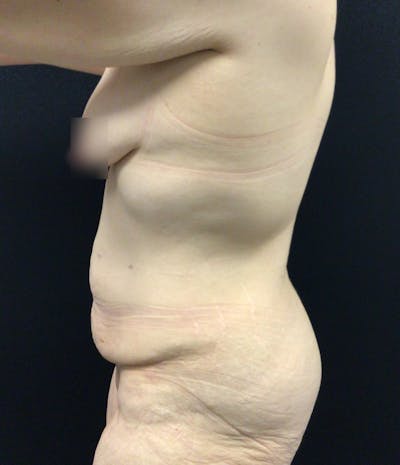 Tummy Tuck Before & After Gallery - Patient 58242645 - Image 5