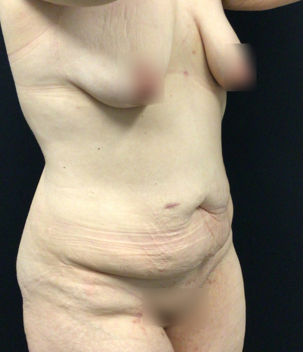 Tummy Tuck Before & After Gallery - Patient 58242645 - Image 3