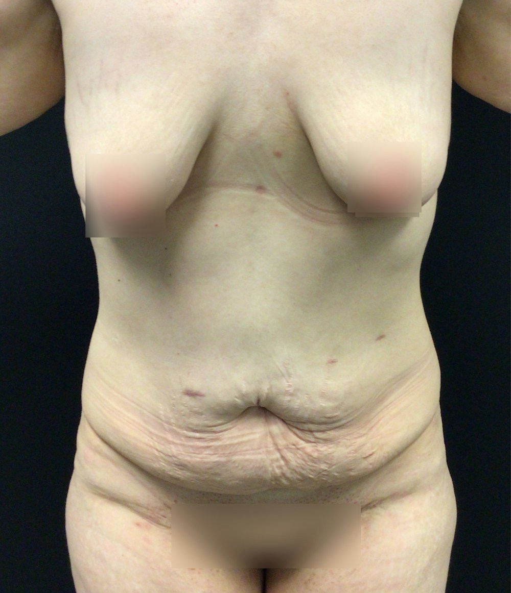 Tummy Tuck Before & After Gallery - Patient 58242645 - Image 1