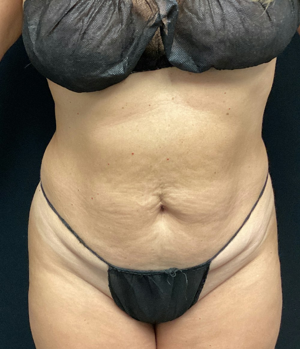 Tummy Tuck Before & After Gallery - Patient 67438657 - Image 1