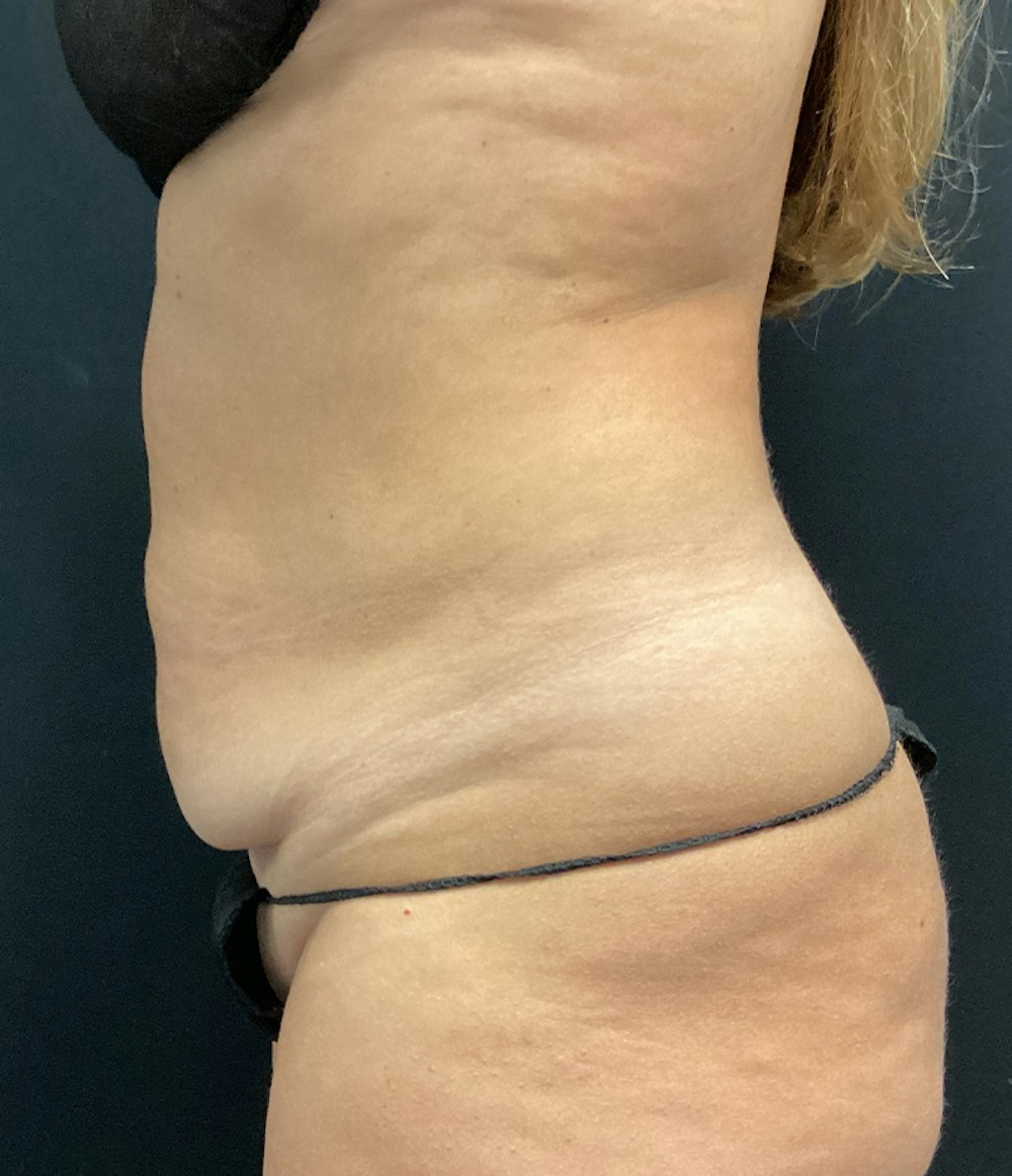 Tummy Tuck Before & After Gallery - Patient 67438657 - Image 5
