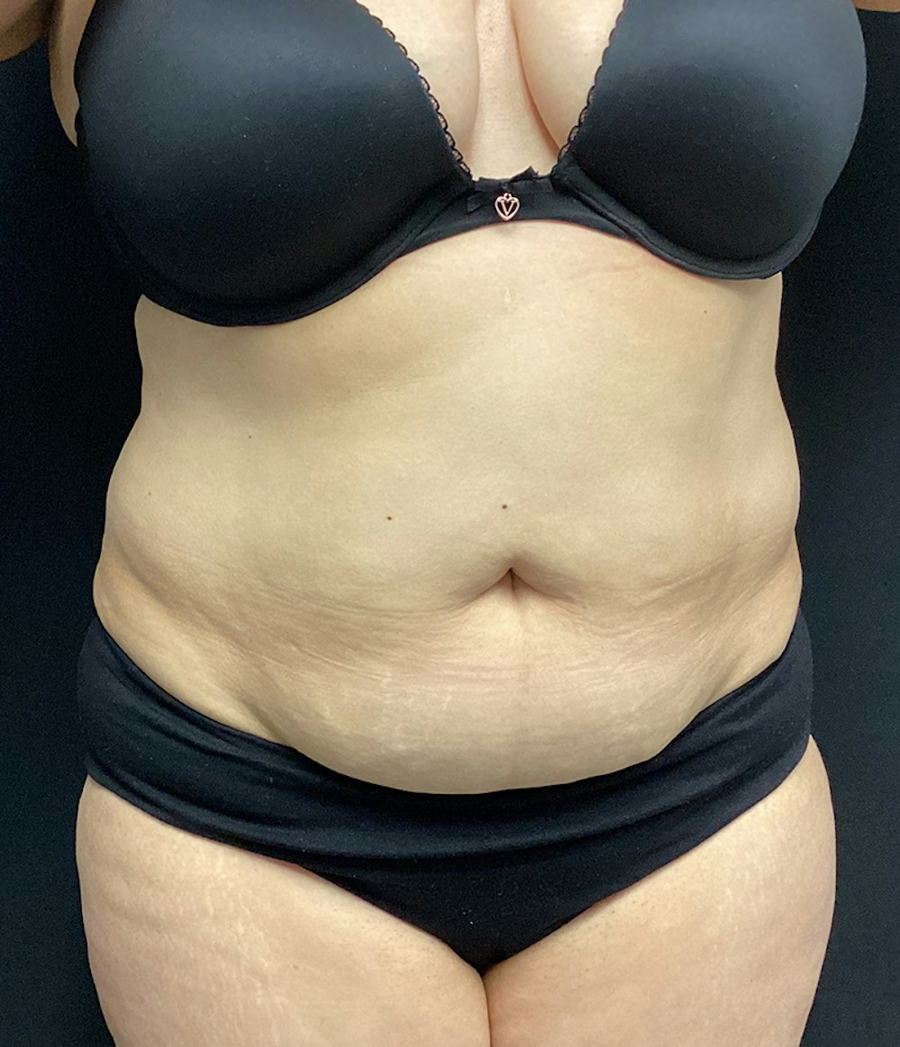 Tummy Tuck Before & After Gallery - Patient 67438674 - Image 1