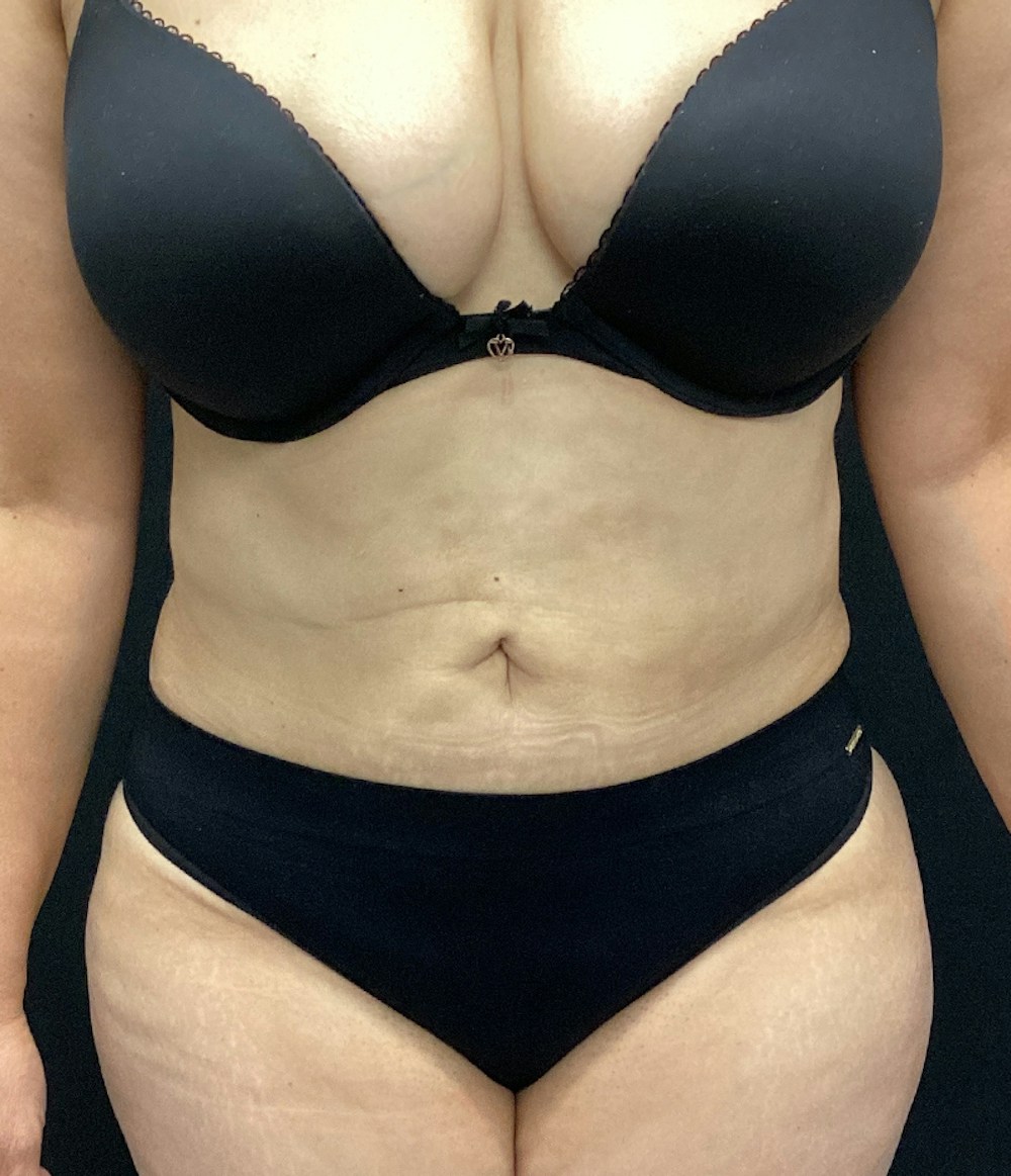 Tummy Tuck Before & After Gallery - Patient 67438674 - Image 2