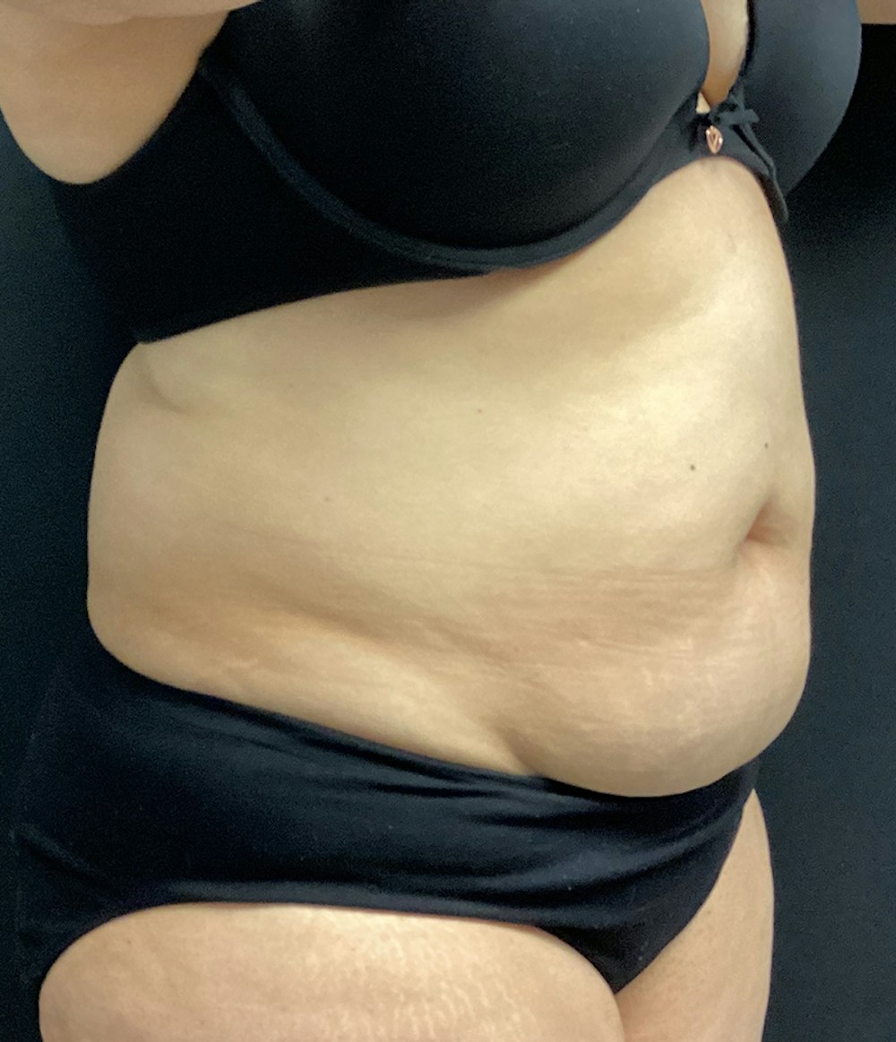 Tummy Tuck Before & After Gallery - Patient 67438674 - Image 3