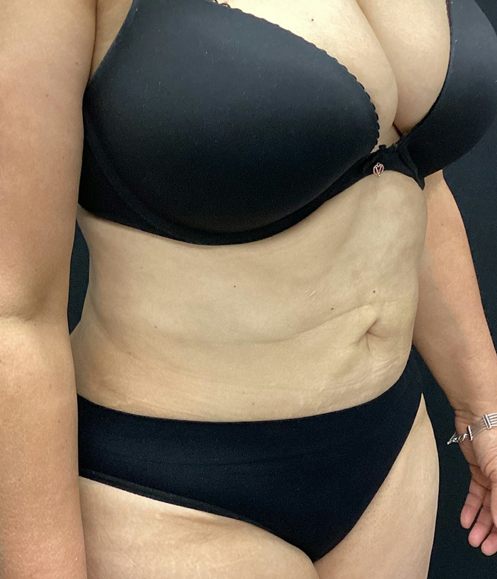Tummy Tuck Before & After Gallery - Patient 67438674 - Image 4