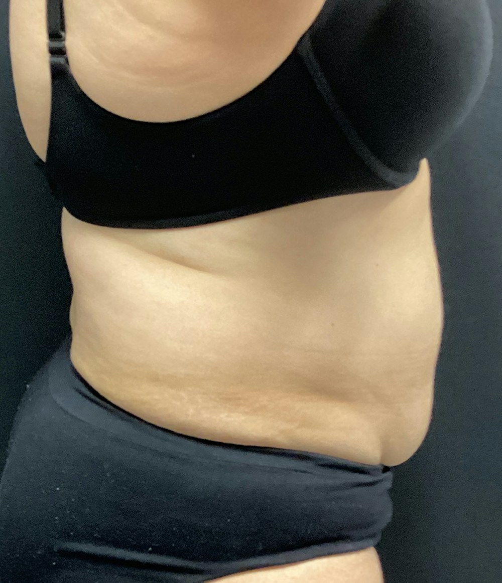 Tummy Tuck Before & After Gallery - Patient 67438674 - Image 5