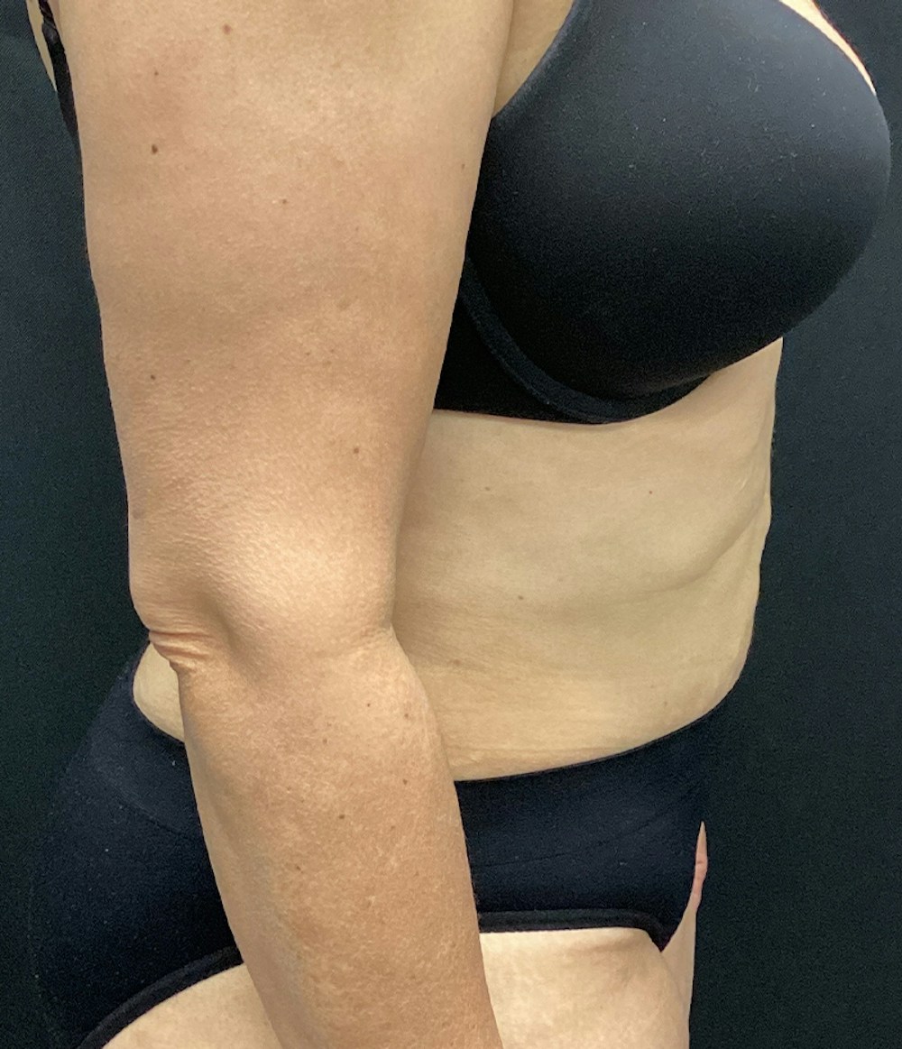 Tummy Tuck Before & After Gallery - Patient 67438674 - Image 6