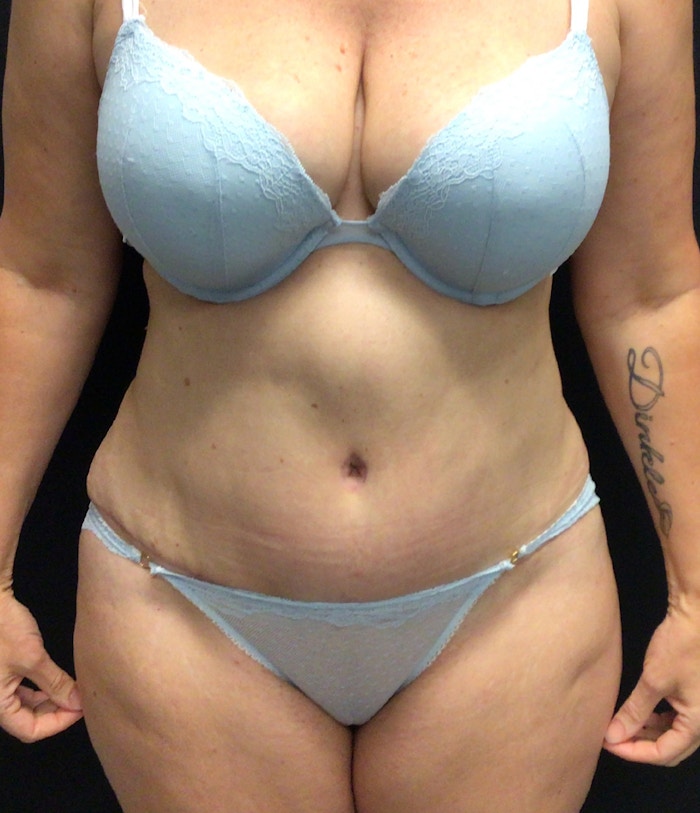 Tummy Tuck Before & After Gallery - Patient 72237399 - Image 2