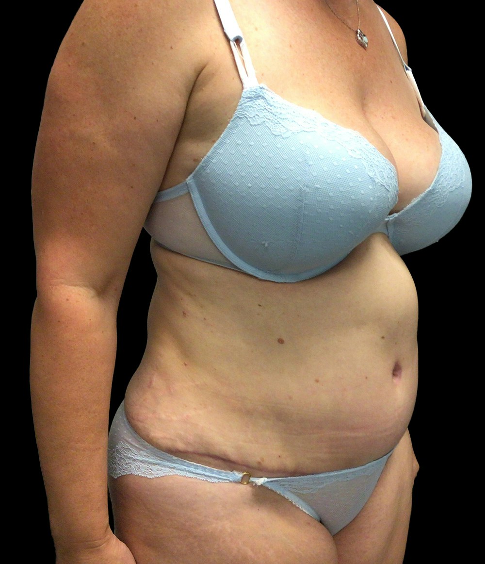 Tummy Tuck Before & After Gallery - Patient 72237399 - Image 4
