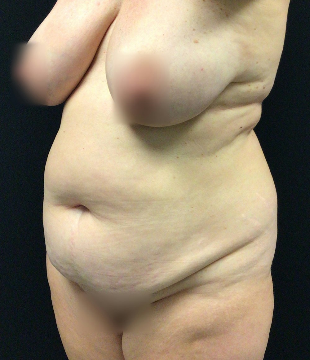Tummy Tuck Before & After Gallery - Patient 72237399 - Image 5