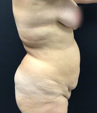 Tummy Tuck Before & After Gallery - Patient 72237397 - Image 3