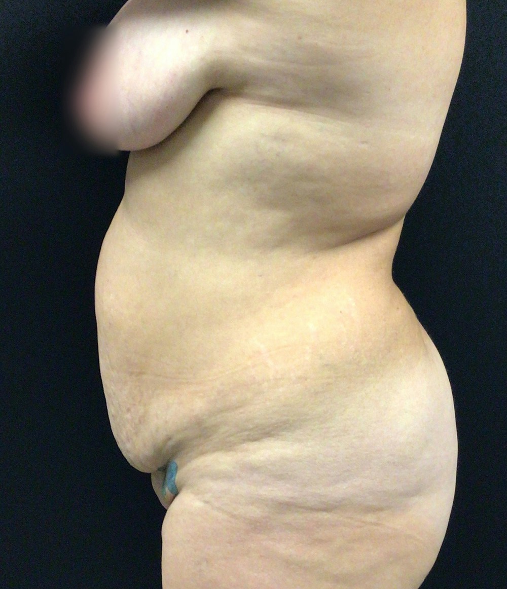 Tummy Tuck Before & After Gallery - Patient 72237397 - Image 5