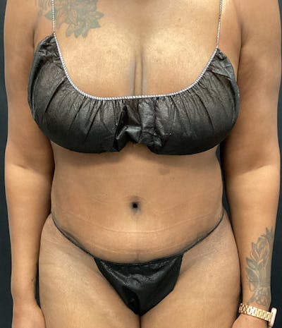 Tummy Tuck Before & After Gallery - Patient 72237395 - Image 2
