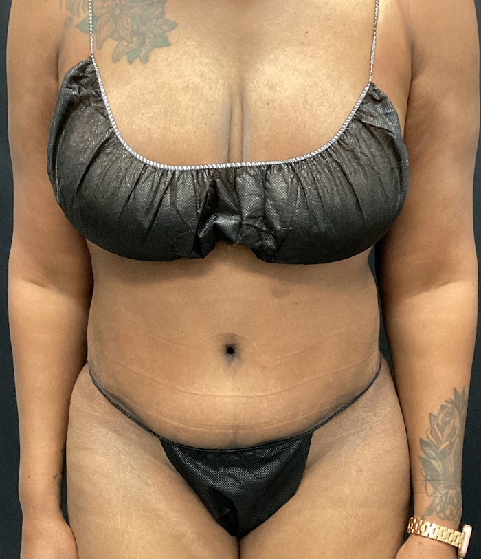 Tummy Tuck Before & After Gallery - Patient 72237395 - Image 2