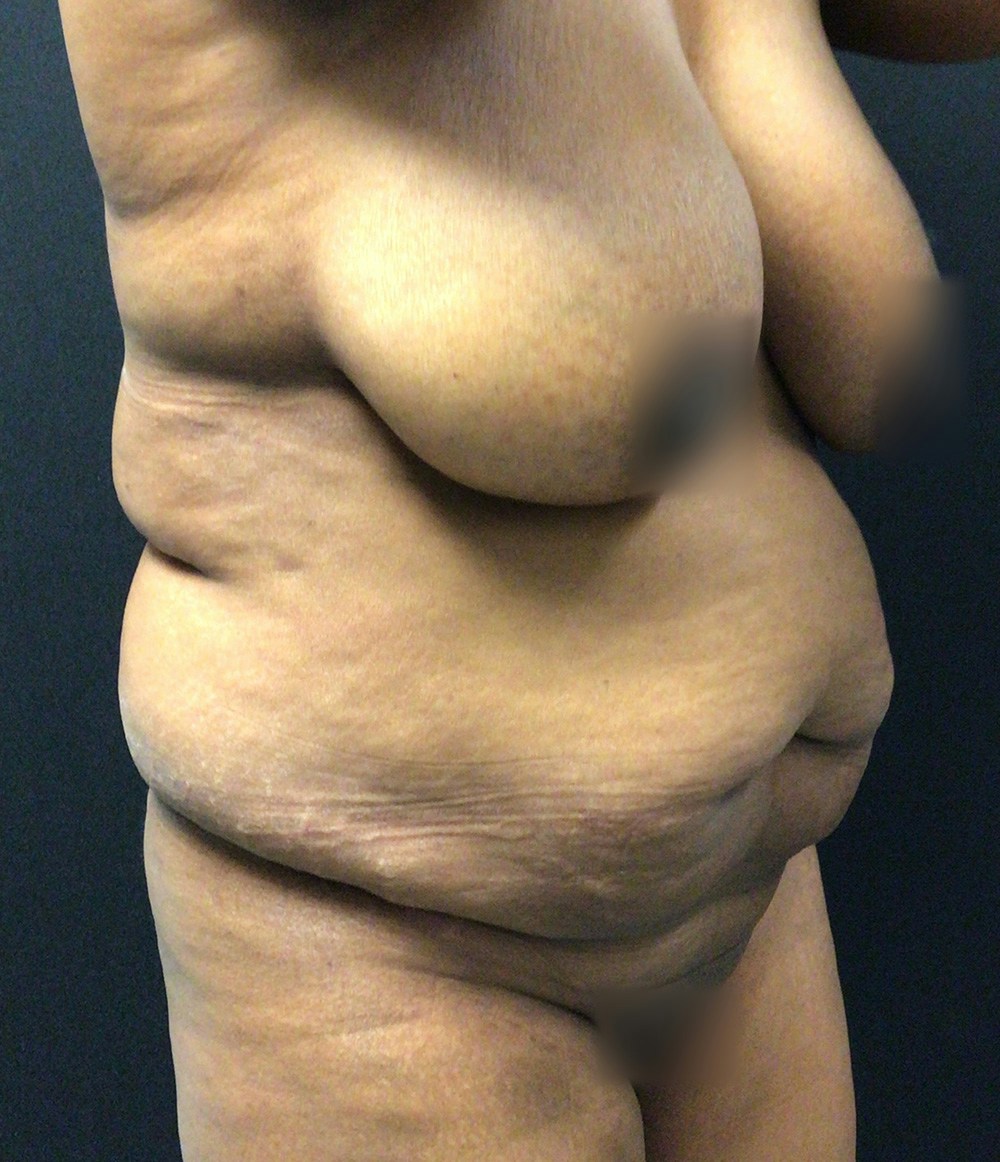 Tummy Tuck Before & After Gallery - Patient 72237395 - Image 3