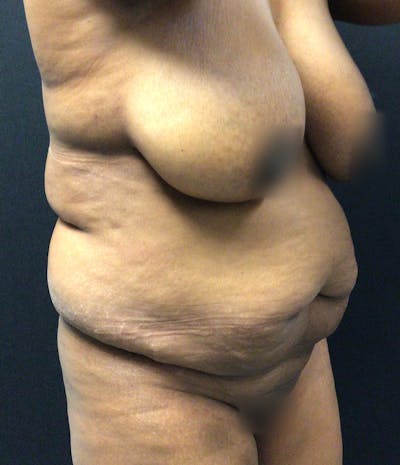 Tummy Tuck Before & After Gallery - Patient 72237395 - Image 3