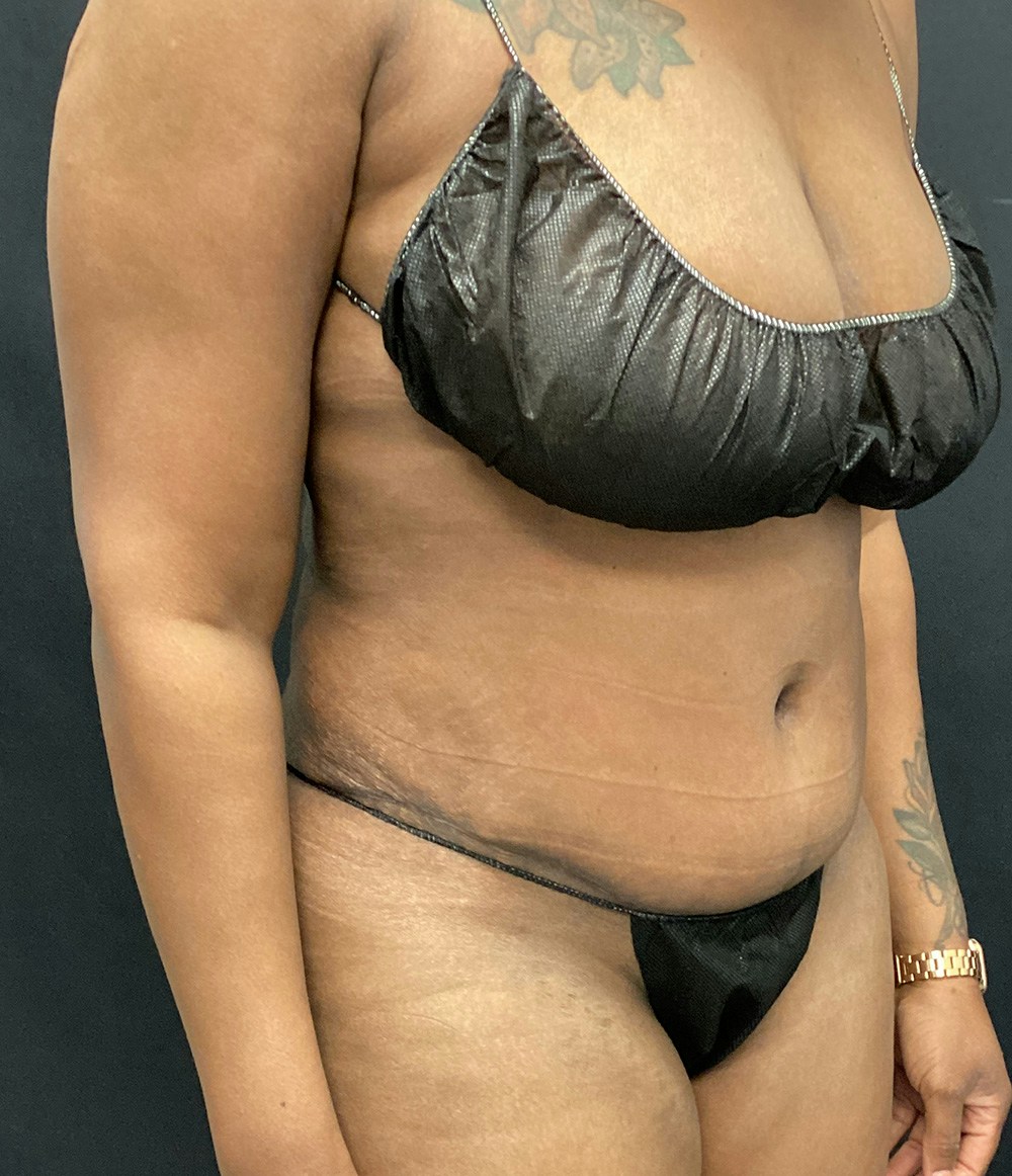 Tummy Tuck Before & After Gallery - Patient 72237395 - Image 4