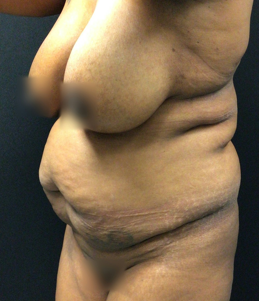Tummy Tuck Before & After Gallery - Patient 72237395 - Image 5