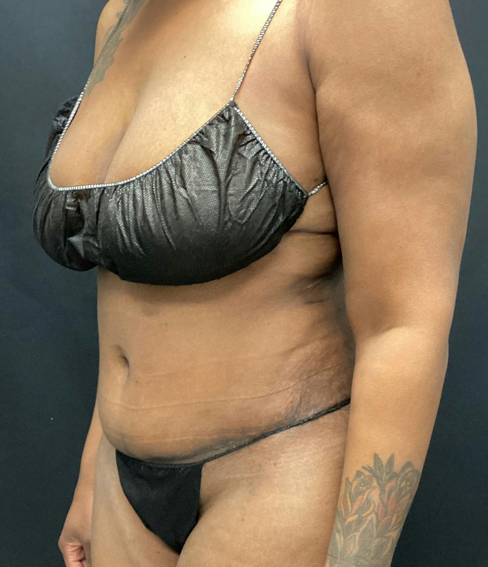 Tummy Tuck Before & After Gallery - Patient 72237395 - Image 6