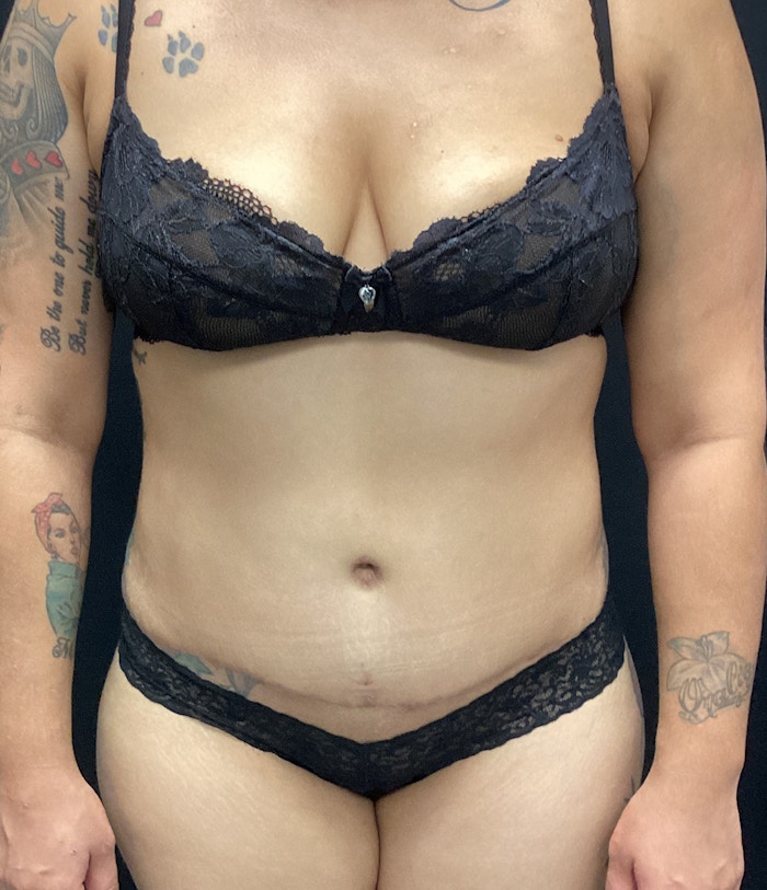 Tummy Tuck Before & After Gallery - Patient 72237394 - Image 2