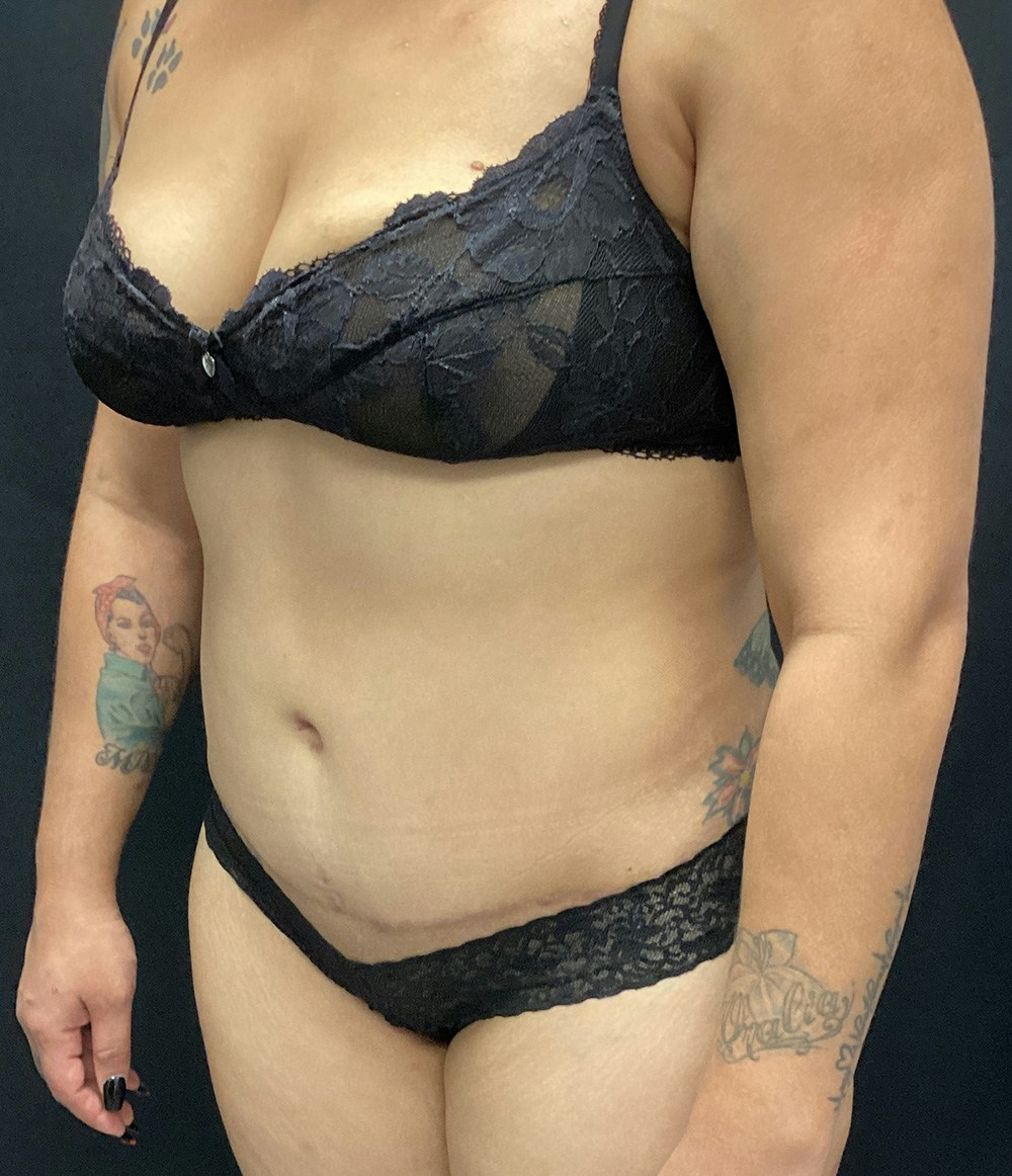 Tummy Tuck Before & After Gallery - Patient 72237394 - Image 4