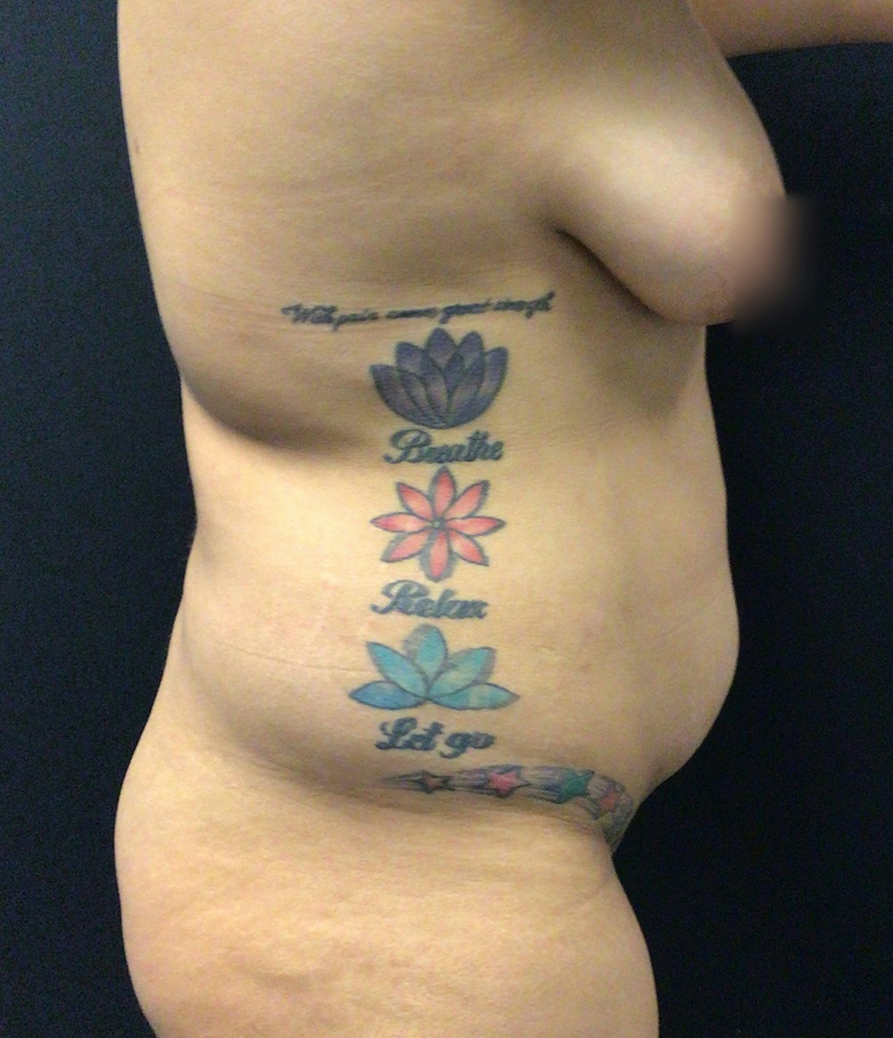 Tummy Tuck Before & After Gallery - Patient 72237394 - Image 5