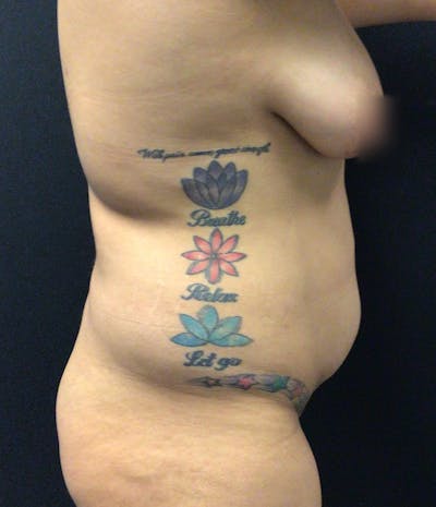 Liposuction Before & After Gallery - Patient 74784377 - Image 5