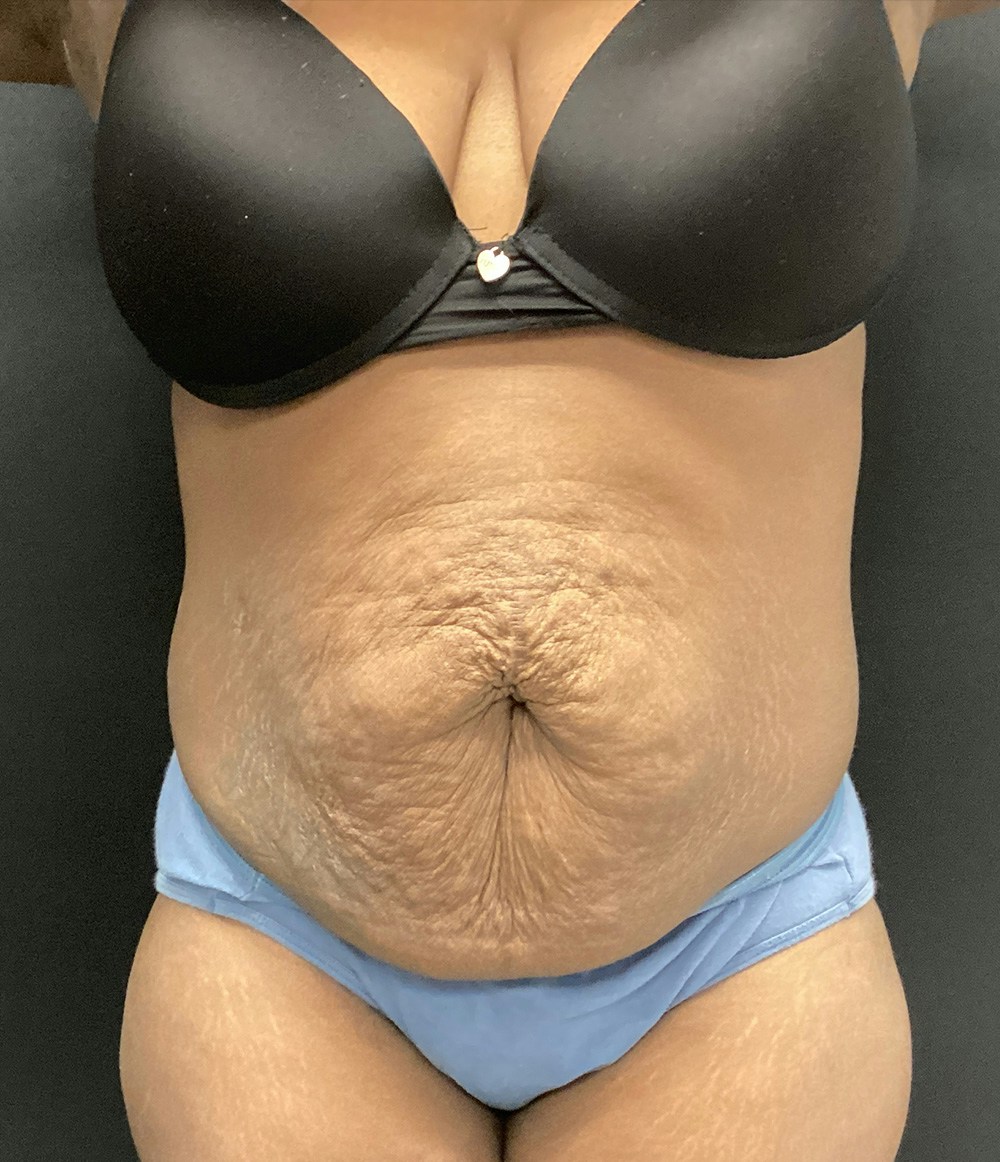 Liposuction Before & After Gallery - Patient 74784373 - Image 1