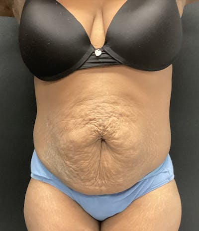 Tummy Tuck Before & After Gallery - Patient 72237393 - Image 1
