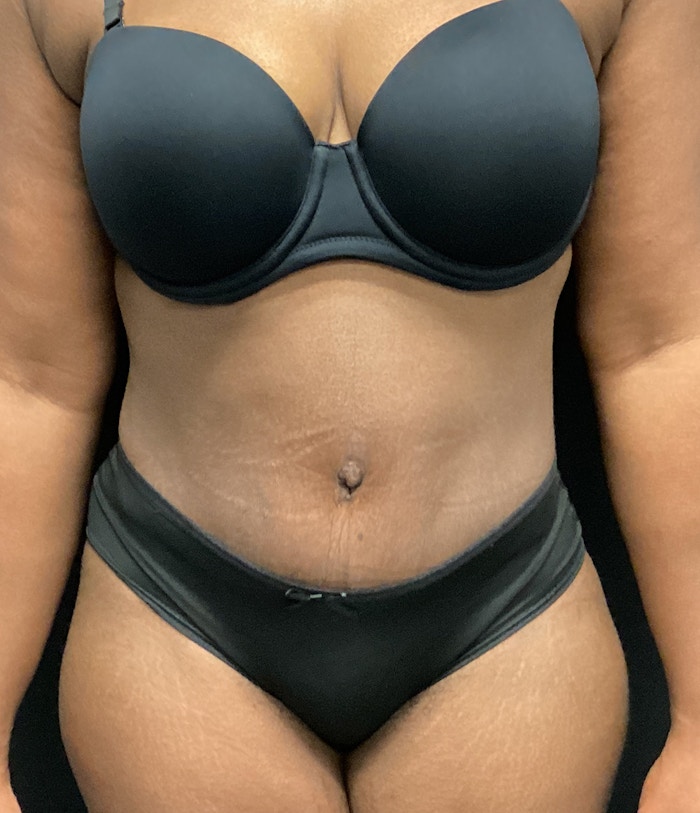 Tummy Tuck Before & After Gallery - Patient 72237393 - Image 2