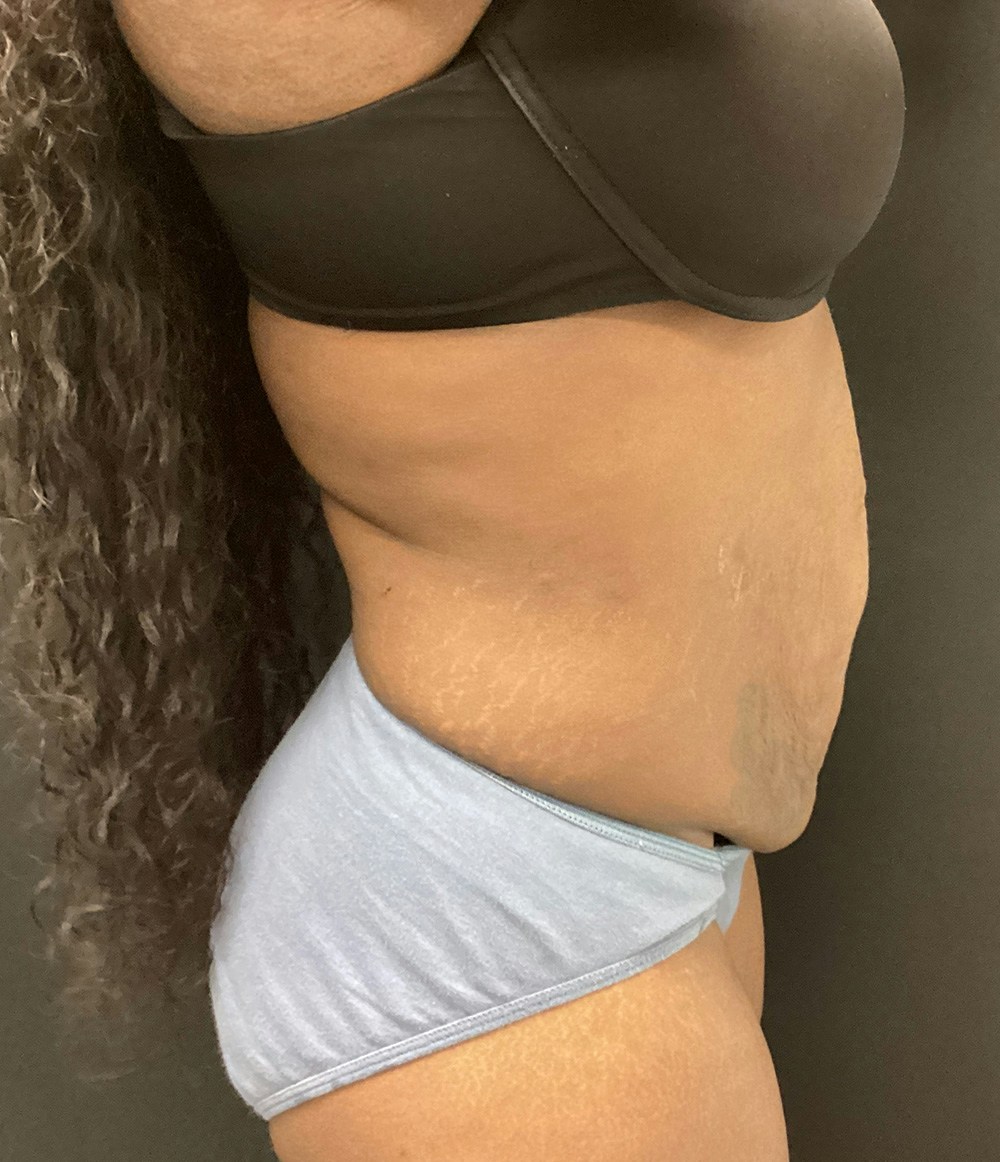 Liposuction Before & After Gallery - Patient 74784373 - Image 3