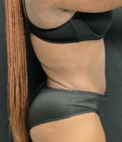 Tummy Tuck Before & After Gallery - Patient 72237393 - Image 4