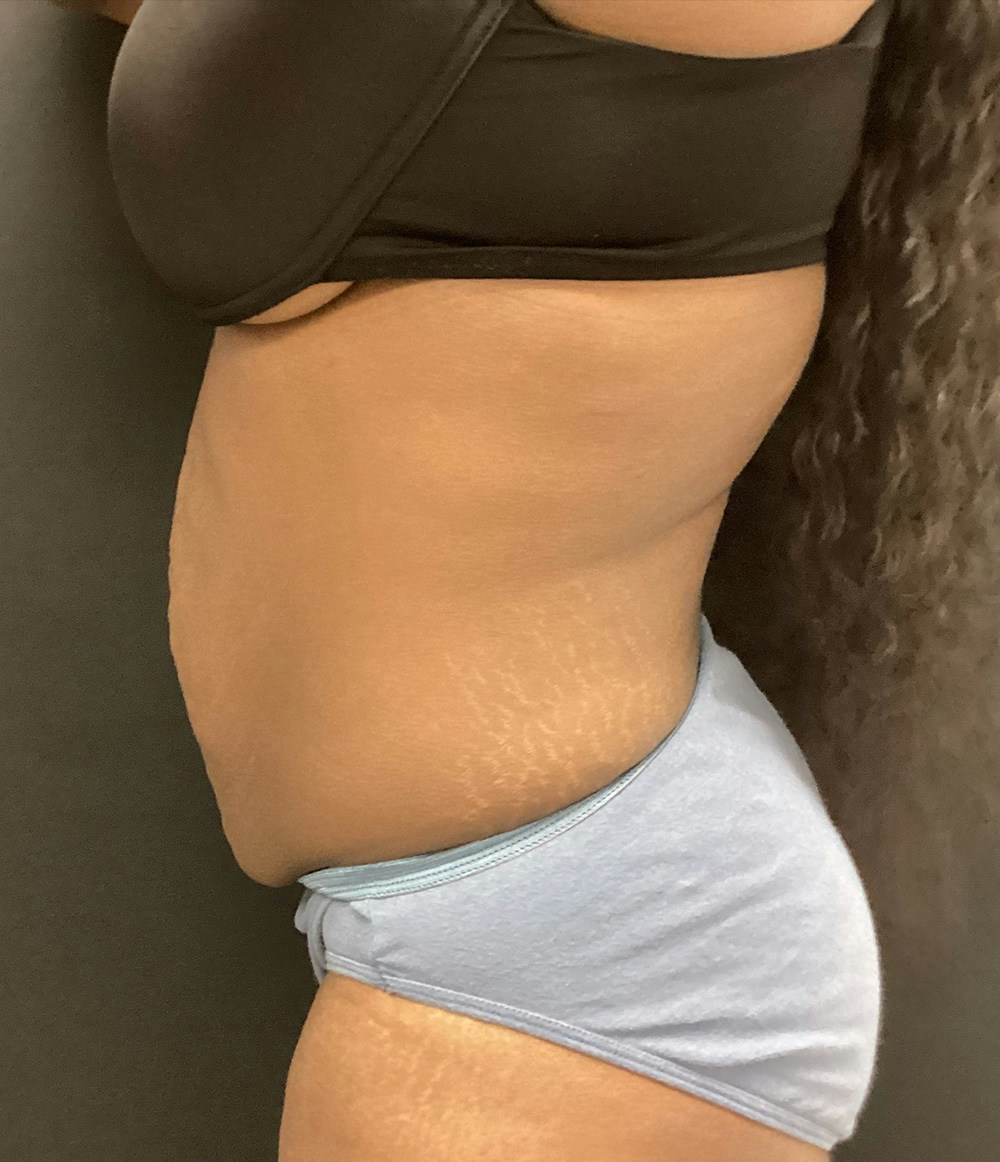 Liposuction Before & After Gallery - Patient 74784373 - Image 5