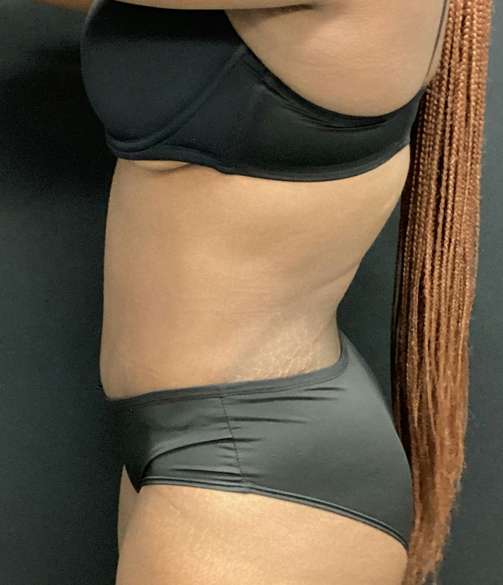 Tummy Tuck Before & After Gallery - Patient 72237393 - Image 6