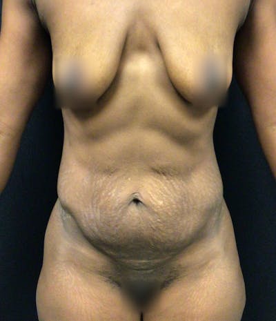 Tummy Tuck Before & After Gallery - Patient 72237392 - Image 1