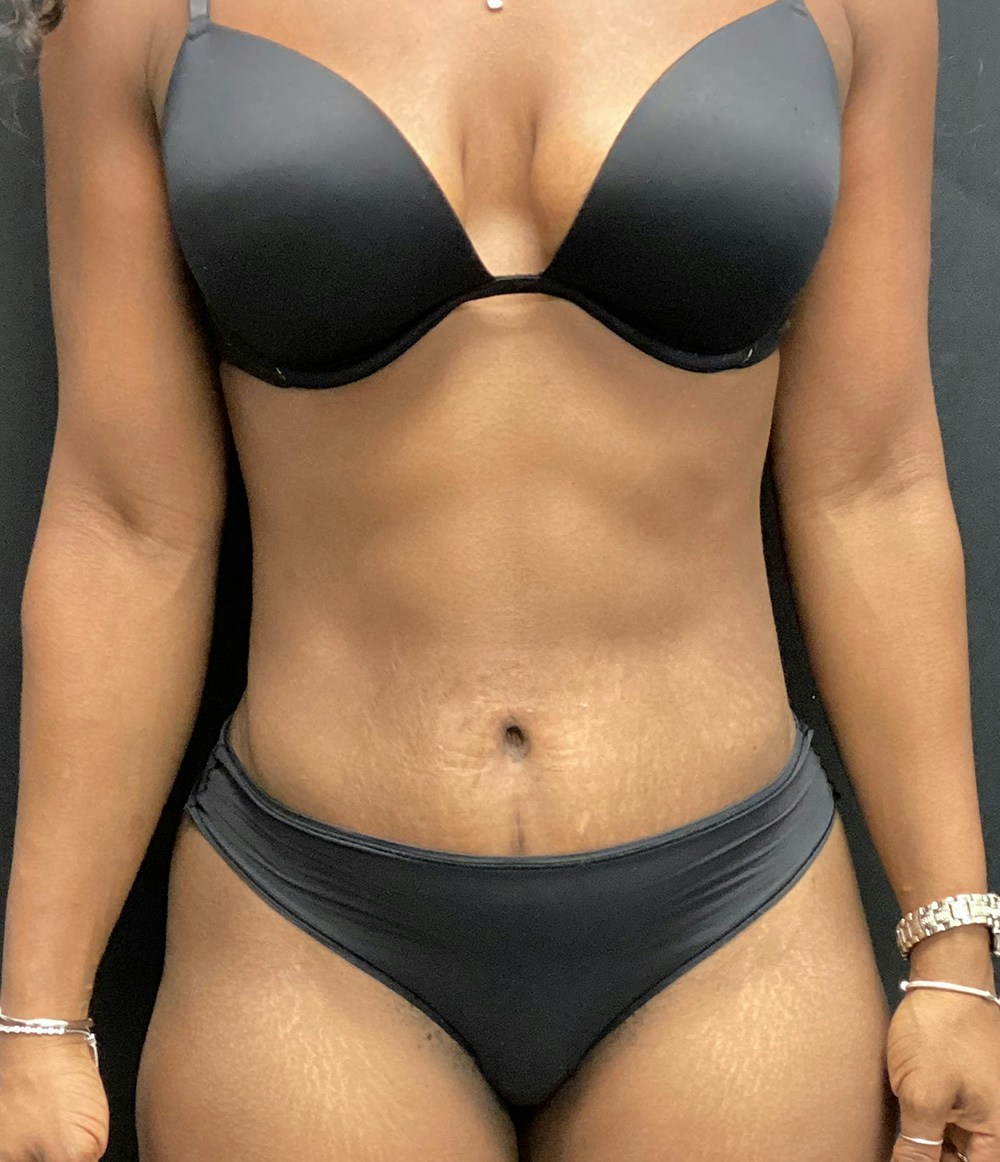 Liposuction Before & After Gallery - Patient 74784372 - Image 2