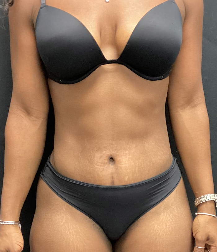 Tummy Tuck Before & After Gallery - Patient 72237392 - Image 2