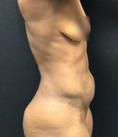 Tummy Tuck Before & After Gallery - Patient 72237392 - Image 3