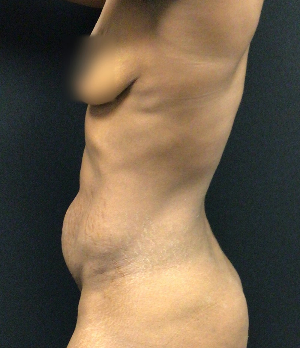 Tummy Tuck Before & After Gallery - Patient 72237392 - Image 5