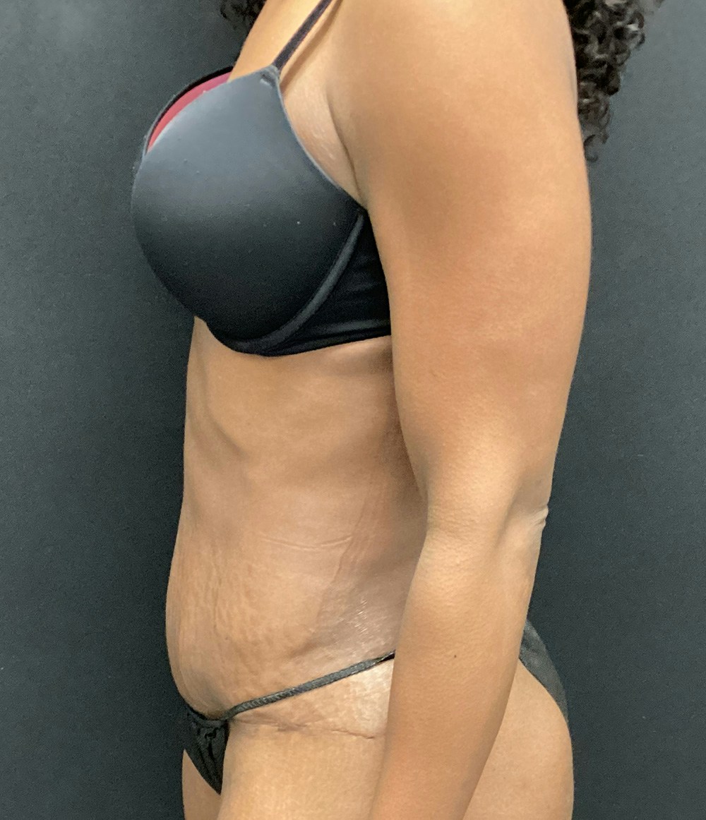 Tummy Tuck Before & After Gallery - Patient 72237392 - Image 6
