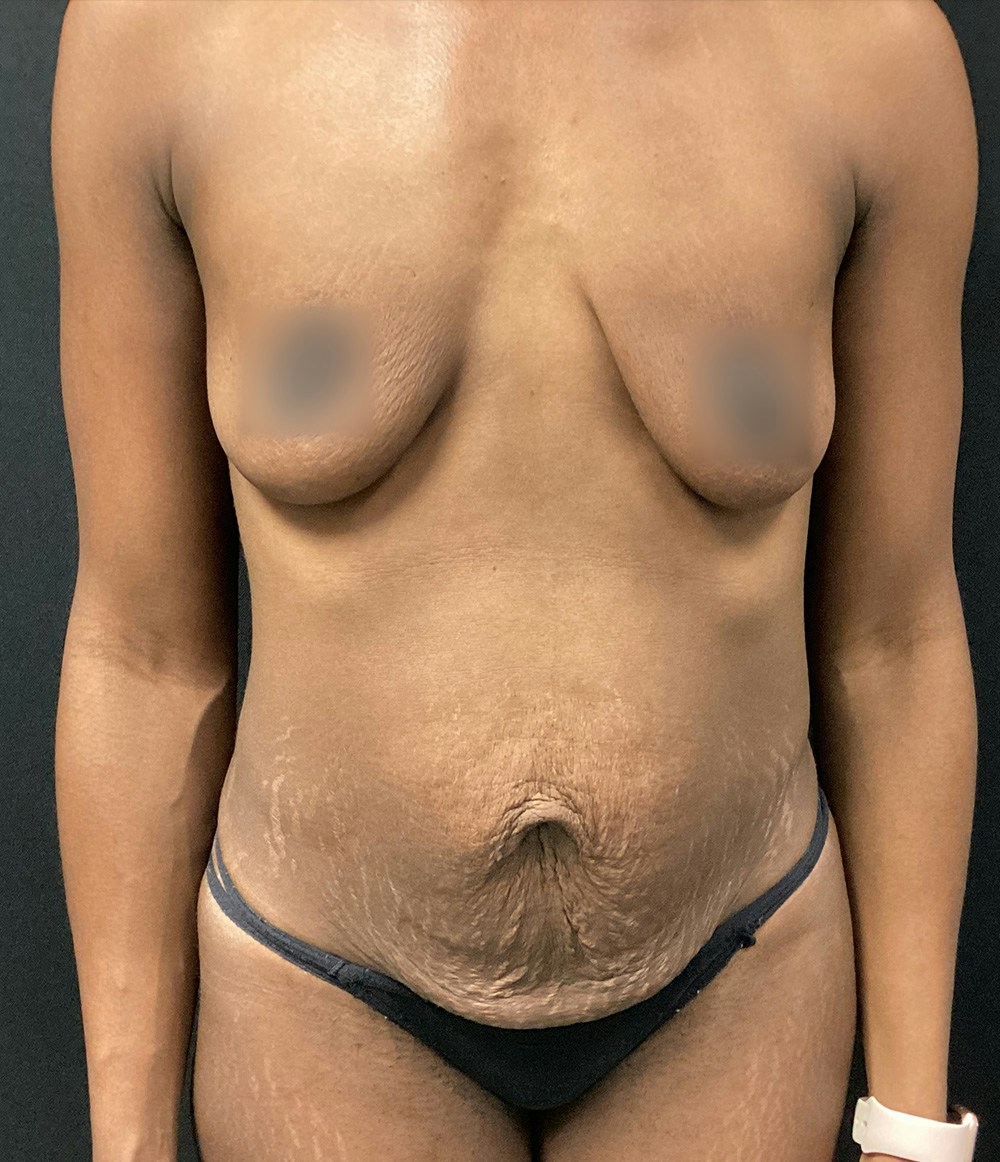 Tummy Tuck Before & After Gallery - Patient 72237391 - Image 1