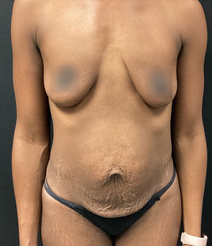Tummy Tuck Before & After Gallery - Patient 72237391 - Image 1