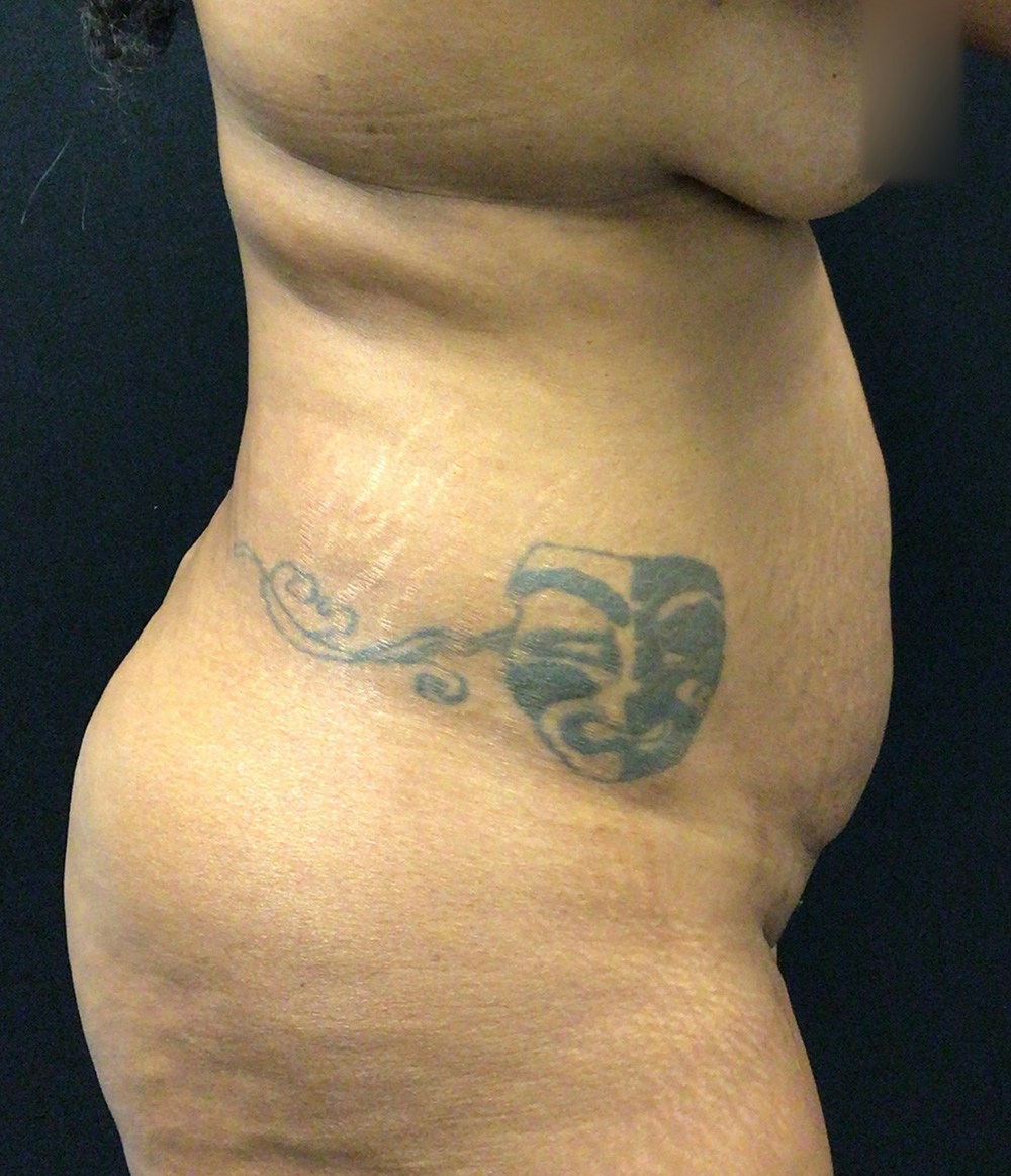 Tummy Tuck Before & After Gallery - Patient 72237390 - Image 3