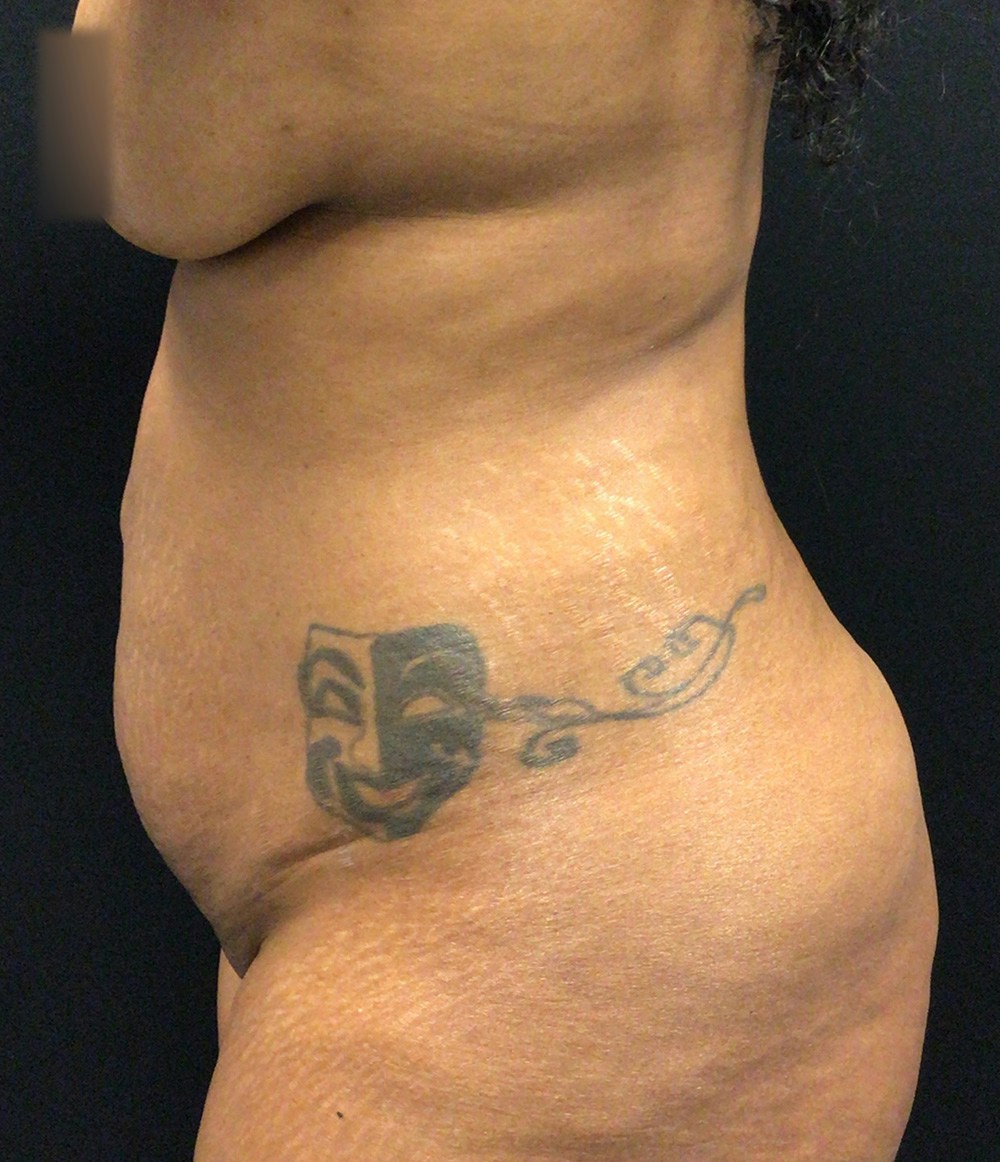Tummy Tuck Before & After Gallery - Patient 72237390 - Image 5