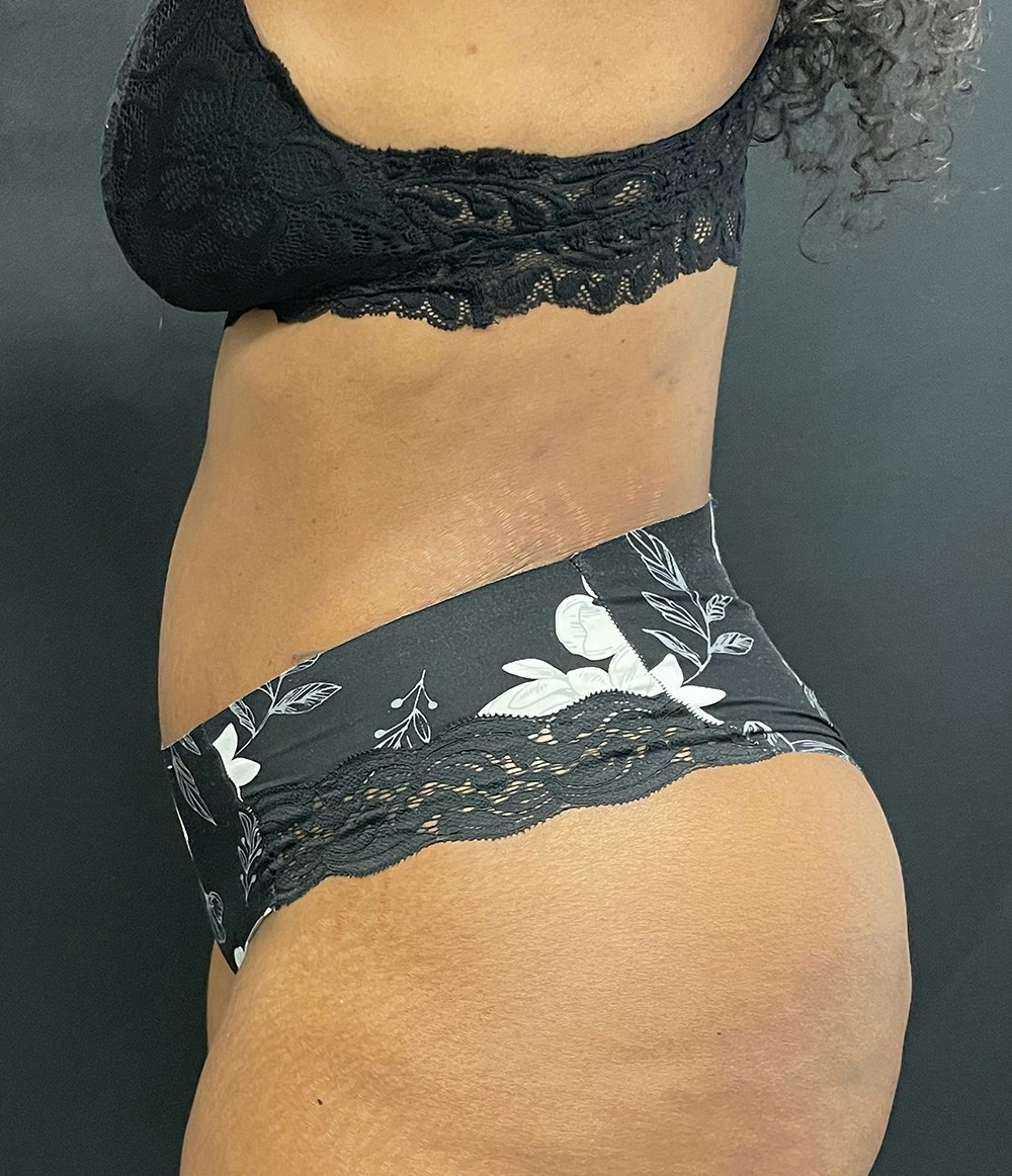 Tummy Tuck Before & After Gallery - Patient 72237390 - Image 6